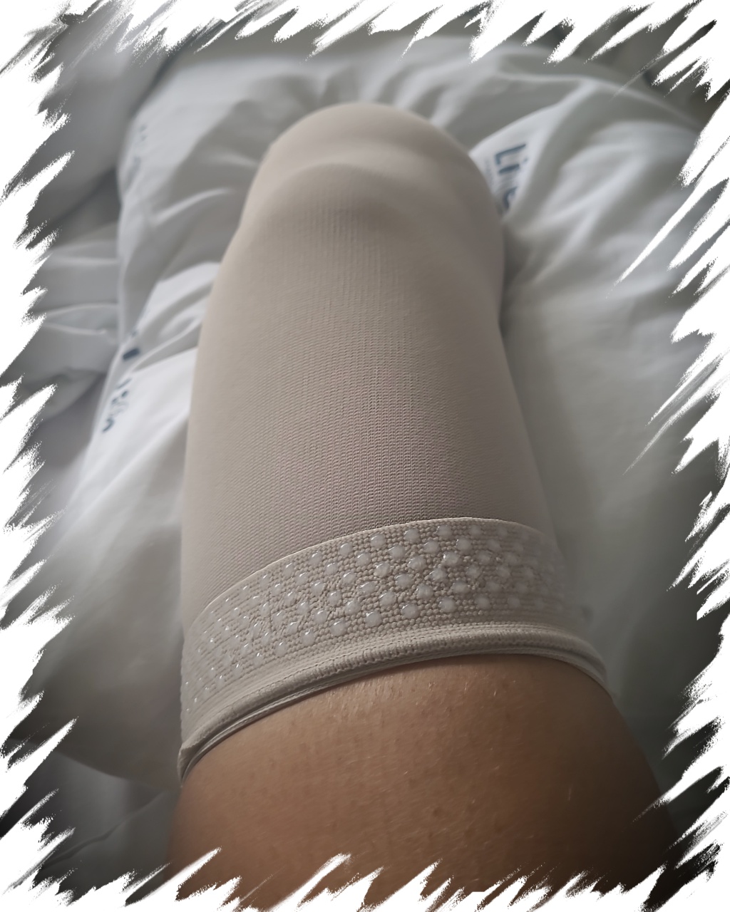 Shays healing stump with a compression stocking on it